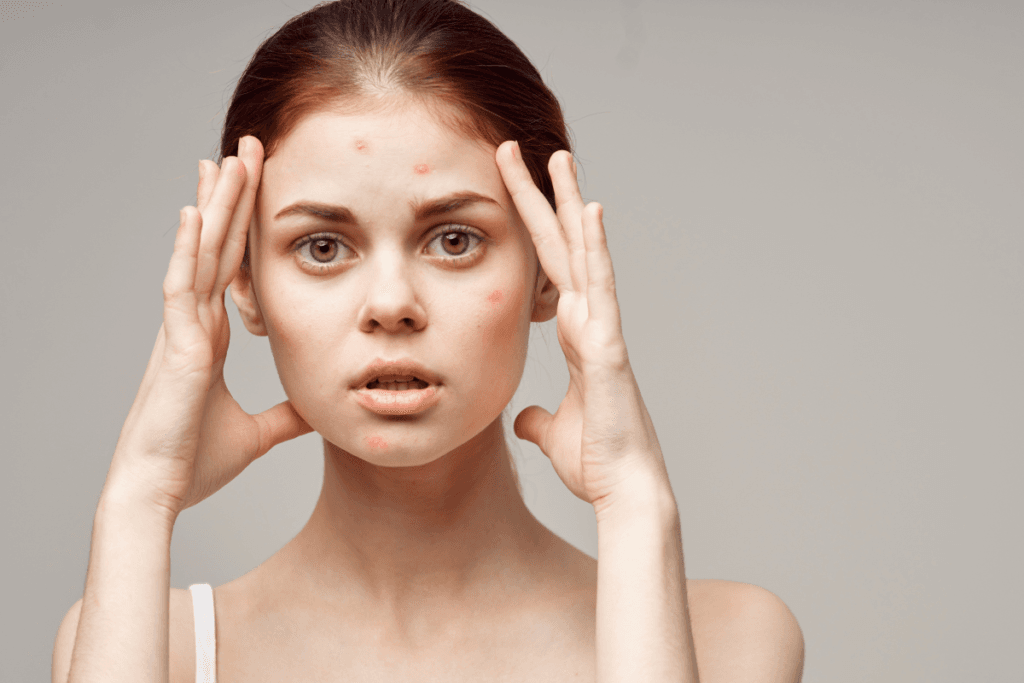 Young woman with acne and breakouts touching her face in frustration – result of poor facial cleansing