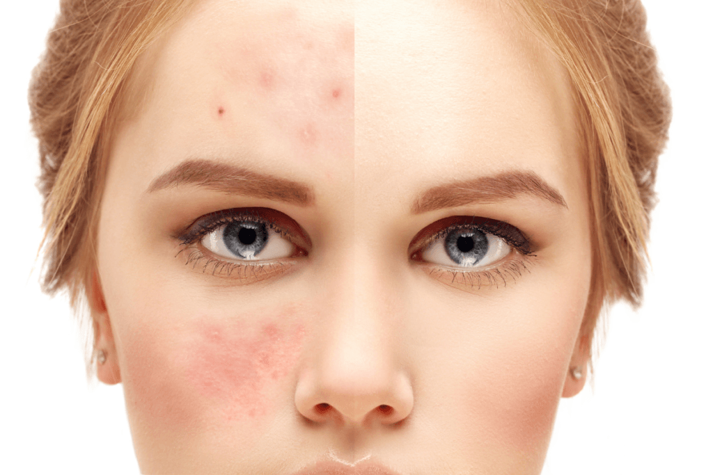 Side-by-side comparison of skin before and after proper face cleansing – visible acne, redness, and clear improvement